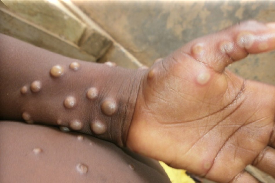 Watch COVID more transmissible than monkeypox, says expert – Latest News