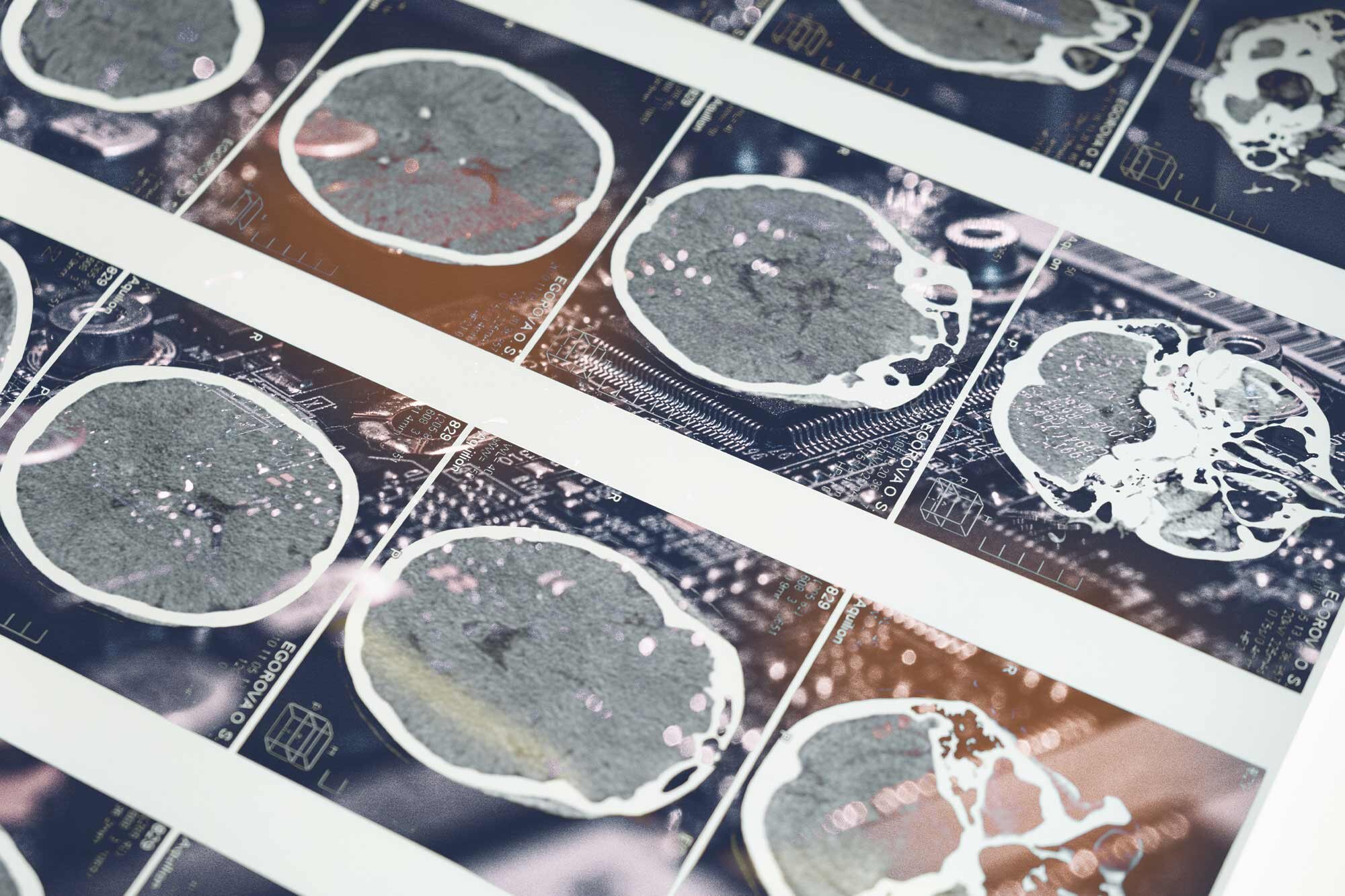 Watch Neuroscientist thinks her AI for brain bleeds can beat human assessments – Latest News